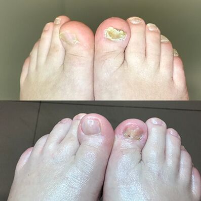 Experiencia en el uso de Barnabas de crema Promicil de Israel, foto antes y después