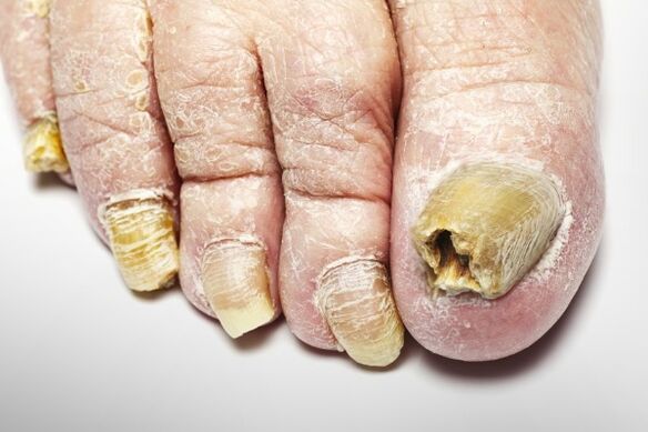 Versión total del hongo de uñas