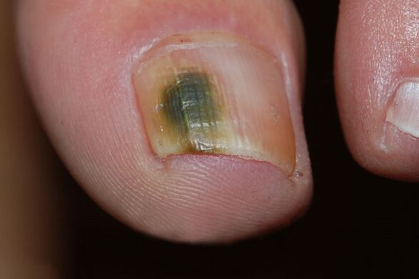 tipo mohoso de hongos de uñas