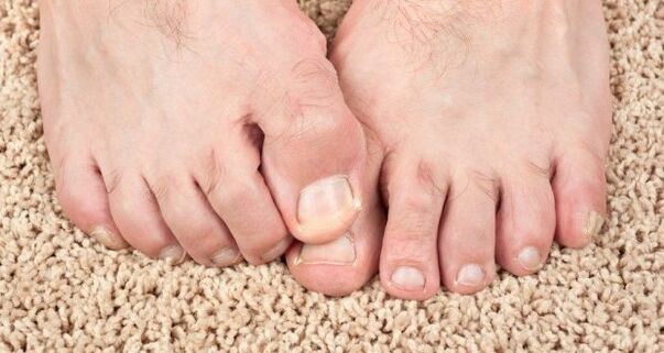 Síntomas del hongo de las uñas