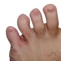 hongo entre los dedos