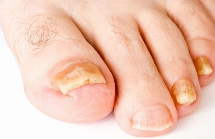 El hongo en el pulgar de la pierna