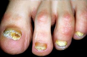 Caracterización de la enfermedad