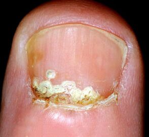 Síntomas y signos de la enfermedad