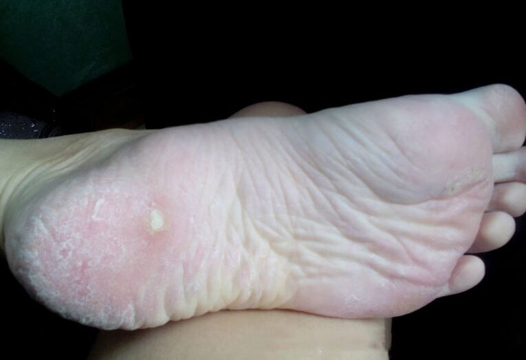 Tratamiento del hongo con un láser