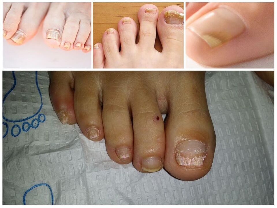 Enfermedades fúngicas de las placas ungueales.