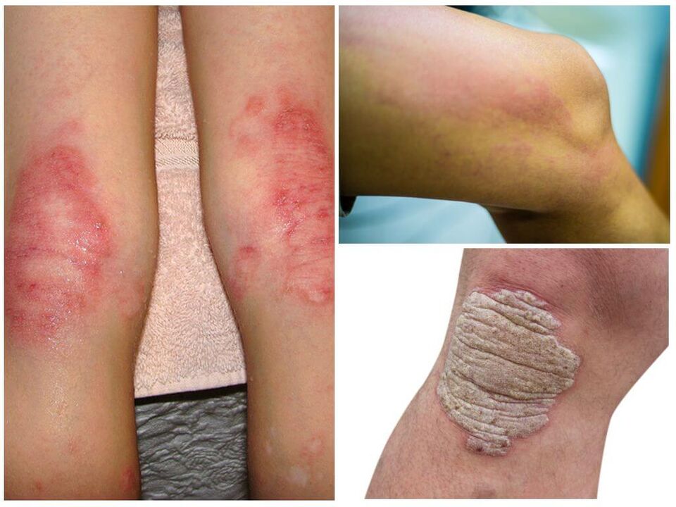 Infecciones fúngicas de las rodillas.