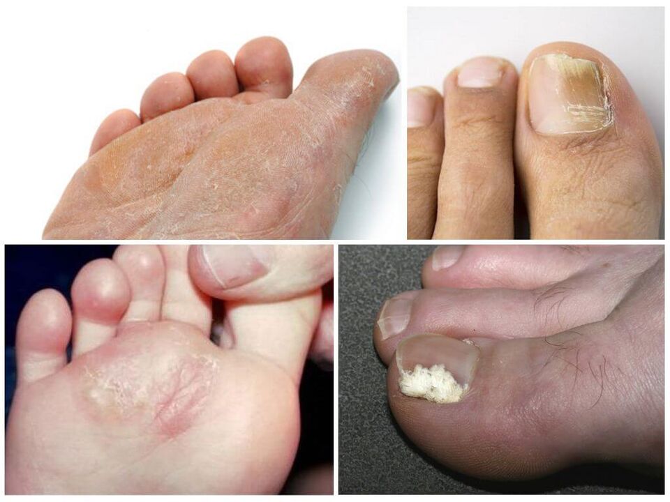 La etapa inicial de los hongos en los pies.