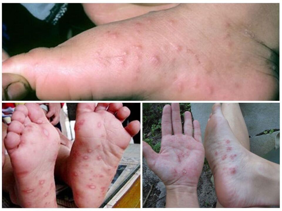 Lesiones hiperqueratósicas de los pies.