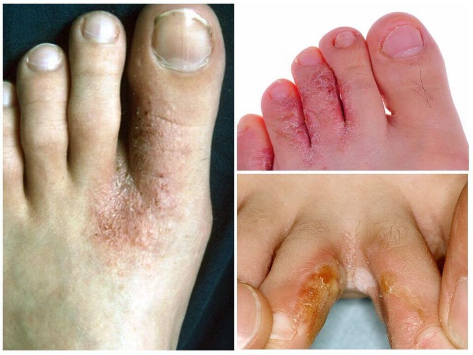 Micosis interdigital