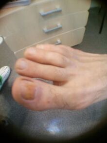 Etapa inicial del hongo en las uñas del dedo gordo.