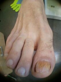 hongos en las uñas del dedo gordo