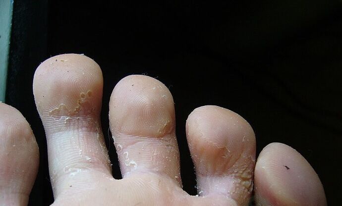 etapa inicial del hongo