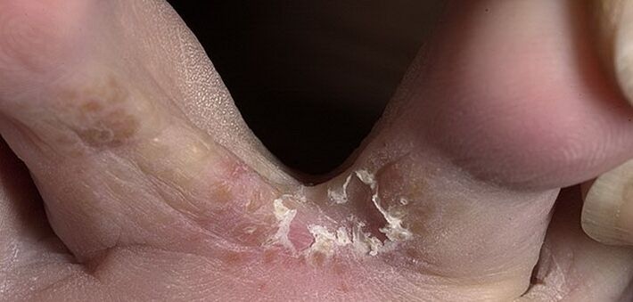 hongos entre los dedos de los pies