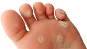 segunda etapa de la infección por hongos