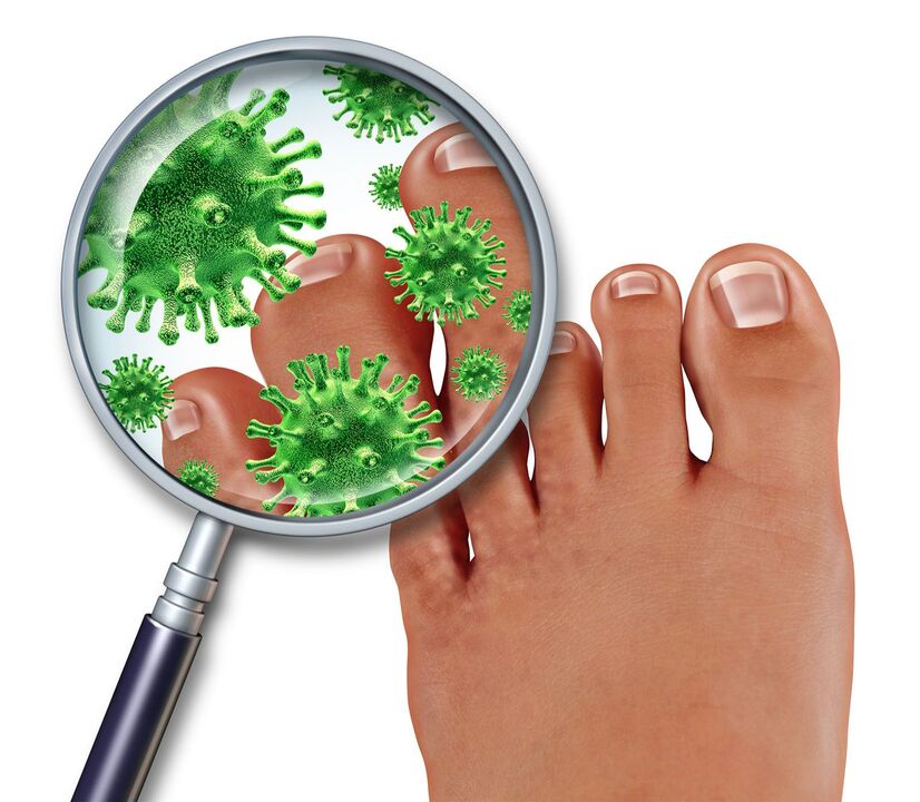 hongos en las uñas de los pies