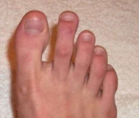 uñas después del tratamiento con láser para hongos