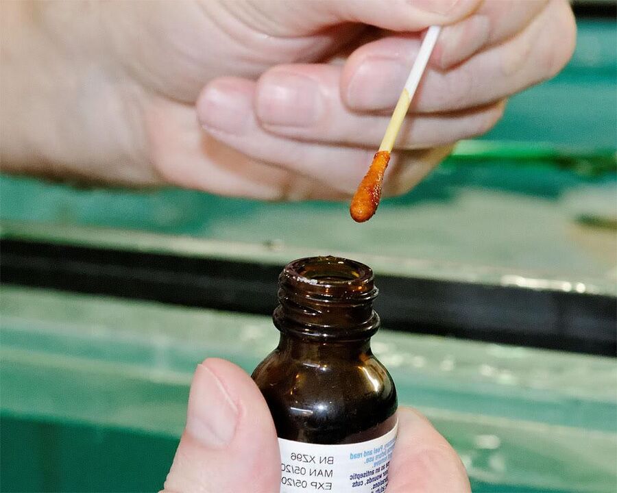 Aplicar una mezcla de yodo y jugo de celidonia en las uñas de los pies eliminará los hongos.
