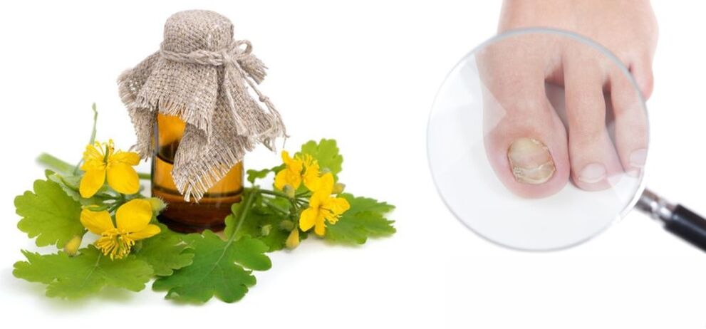 Celidonia para hongos en las uñas de los pies
