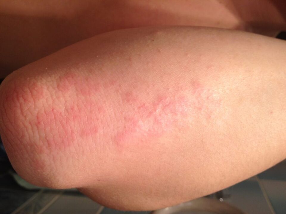 Una reacción alérgica en forma de erupción en la piel del codo después de aplicar una gota de jugo de celidonia.